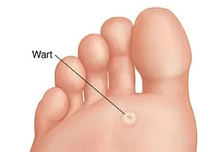 Avenel Podiatrist | Avenel Plantar Warts | | Family Podiatry Center |