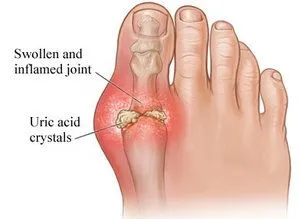 Avenel Podiatrist | Avenel Gout | | Family Podiatry Center |