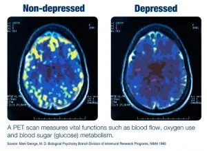 How Does NeuroStar TMS Work?