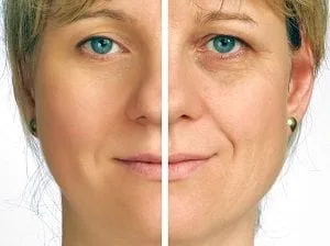before and after of a woman with wrinkles reduced