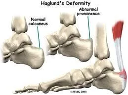 Haglund deformity on sale