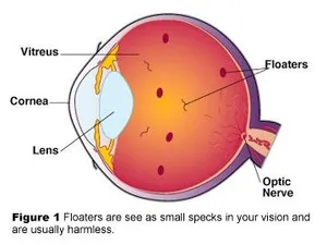 vitreous humor floaters