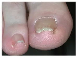 Ingrown Toenails - Foot Condition - Academy Clinics