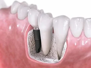 lewelling dental care