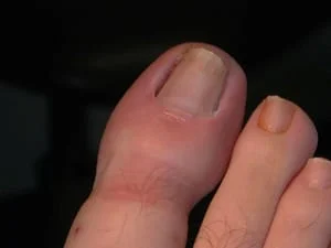 Ingrown Toe Nail - Orangeville Foot Clinic