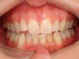 invisalign