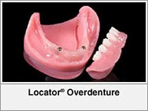 Dental Implants Cedar Rapids, IA