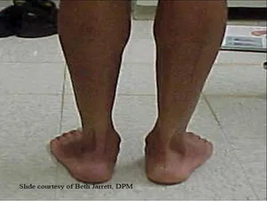 Flat Feet