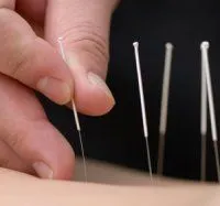 acupuncture.jpg