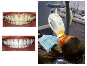 ZOOM Teeth Whitening Image