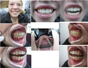 Cosmetic Orthodontics in Port Orchard, WA - After Treatment