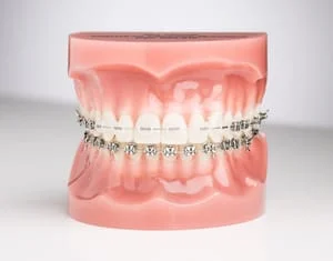 traditional-ceramic-braces-1.jpg