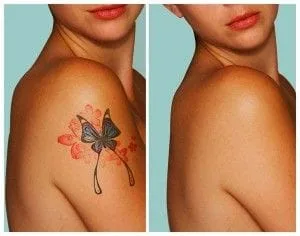 Tattoo Removal at the Fountain Clinic in Rocky River
