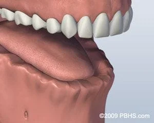 Bridgeport Fairfield Denture Implants - before