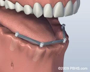 Bridgeport Fairfield Dental Implants placed in jaw