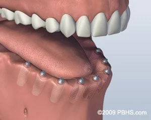 Individual Dental Implants placed in jaw, Bridgeport Fairfield CT
