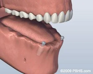 Dental Implants placed in jaw, Bridgeport Fairfield CT