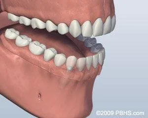 Denture attached to Dental Implants Bridgeport Fairfield CT