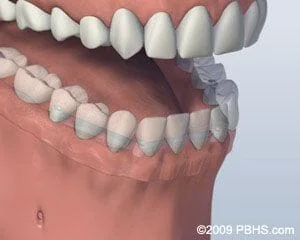 Denture all on 4 Dental Implants Fairfield Bridgeport