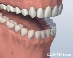 Denture supported by Dental Implants Fairfield Bridgeport