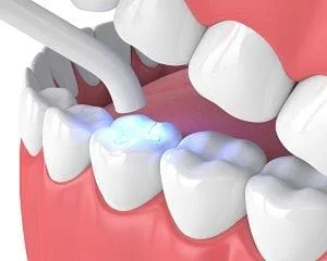 Dental Tooth Fillings