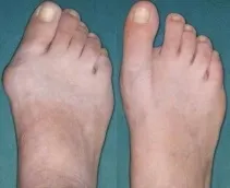 Blackmer Foot & Ankle  Hallux Rigidus Big Toe Joint Arthritis) in Meridian