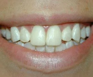 Dental Bonding | Dentist In Lafayette, LA | LeBlanc General and Cosmetic Dentistry