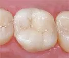 White Fillings