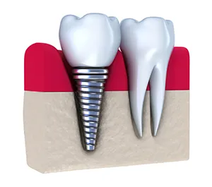 illustration of implant embedded in gum next to natural tooth, dental implants Washington DC dentist