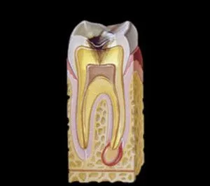 root-canal