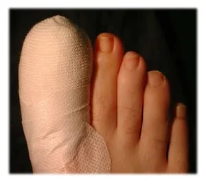 Ingrown Toenails Treatment  Foot Doctor North Andover, MA 01845