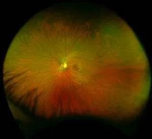 Healthy Retina 