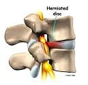 herniated_disc.png