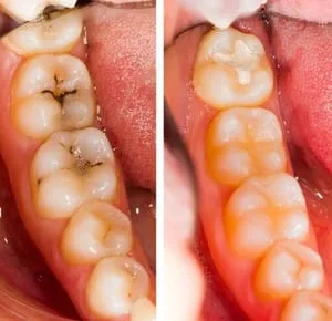 old-and-unsightly-fillings