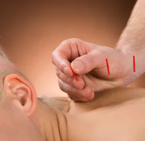 acupuncture