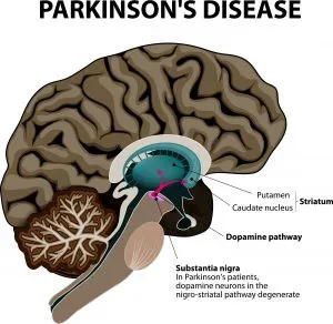 NUCCA and Parkinsons Disease