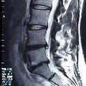 Disc Injuries