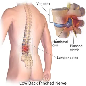 What Causes Herniated Discs?