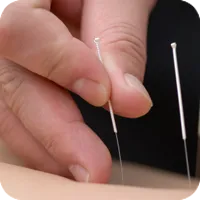 acupuncture