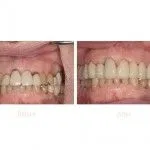 Before Treatment and After Treatment