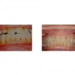 Before and After Treatment with Invisalign and Bonded Restoration