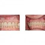 Before and After Color Correction with Ceramic Restoration