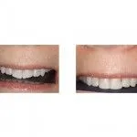 Before and After Restoration with Bonded Restoration