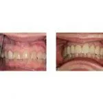 Before and After Dental Treatment
