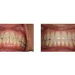 Before and After Dental Treatment