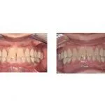 Before and After Dental Treatment