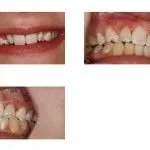 Before and After Ceramic Restoration for Misaligned Teeth