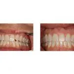 Before and After Dental Treatment
