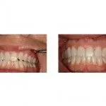 Before and After Treatment