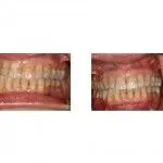 Before and After Treatment of Eroded and Discolored Teeth with Bonded Restoration and Crowns